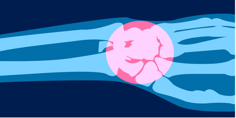 X-ray image of hand pain ilustration. 2D Picture rontgen of Hand bone in painful injury damage. Vector illustration