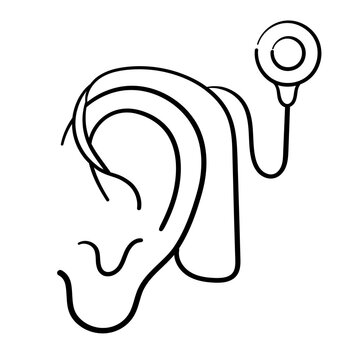cochlear implant