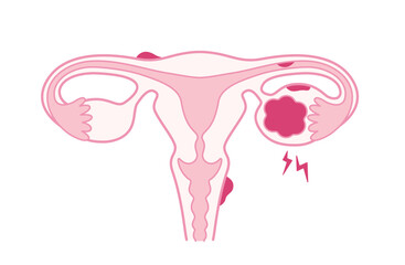 子宮内膜症・チョコレート囊胞で痛みがある子宮