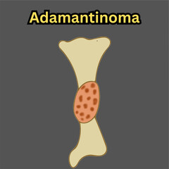 adamantinoma non cancerous bone tumor in long bone illustration useful for educational and healthcare industries orthopedics