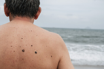 The back of an elderly man with freckles, aging spots, black, brown warts and wrinkles against the background of the sea