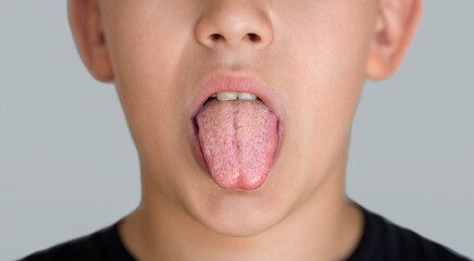 Close-up of a little boy tongue with bacterial patina due to poor oral hygiene or poor nutrition....