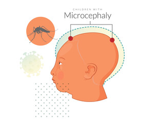 Children with microcephaly - Zika Virus - Stock Illustration