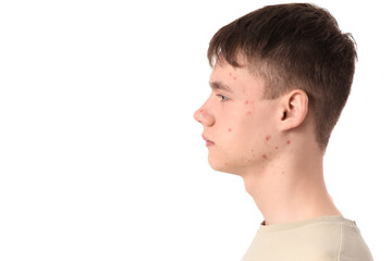 Obraz premium Teenage boy with acne on white background, closeup