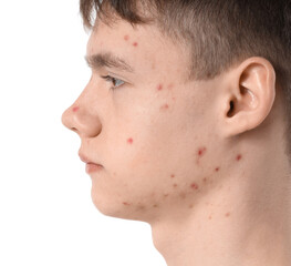 Teenage boy with acne on white background, closeup