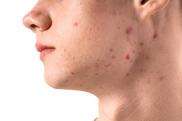 Teenage boy with acne on white background, closeup
