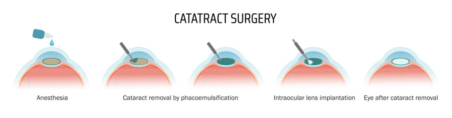 Vectorial medical poster cataract surgery. Stages of lens removal and replacement with a new lens.
