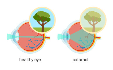 Vector medical poster of anatomy of healthy eye and eye with cataract.
