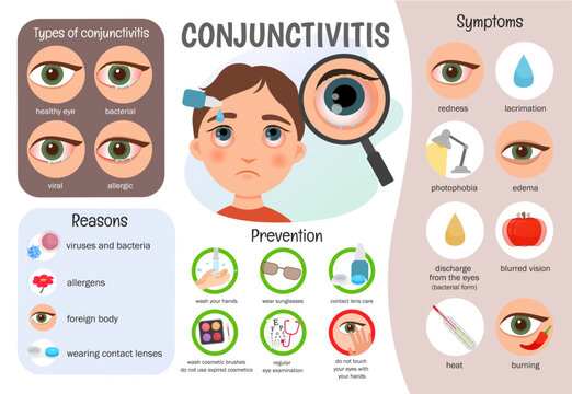 Vector infographics conjunctivitis. Medical poster types of disease, symptoms, prevention.
