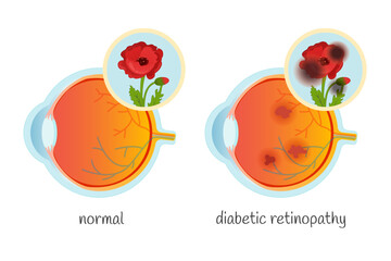 Vector medical poster normal eye and eye with diabetic retinopathy.
