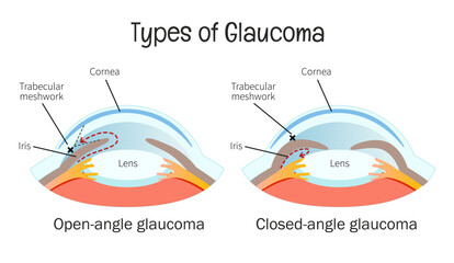 Vector medical poster types of glaucoma. Open-angle and closed-angle glaucoma on eye anatomy. 
