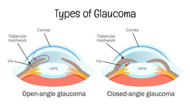 Vector medical poster types of glaucoma. Open-angle and closed-angle glaucoma on eye anatomy.
