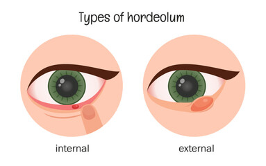 Vector medical illustration of hordelium types.
