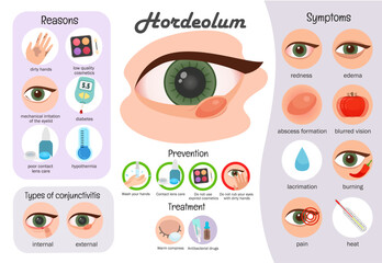 Vector medical poster hordeolum. Inforgraphics infectious eye diseases.
