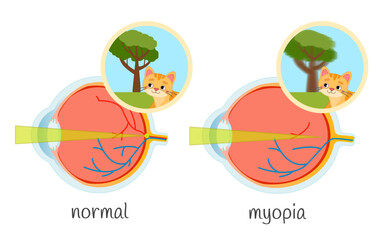 Vector medical illustration of vision impairment. Eye diseases myopia, normal.
