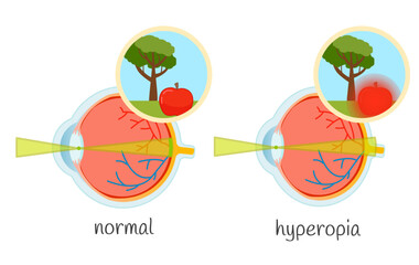 Vector medical illustration of vision impairment. Eye diseases hyperopia, normal.
