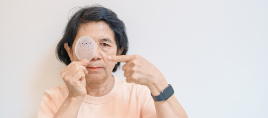 Elderly Woman with eye protective shield after eye surgery. Eye disease, Cataract,  Glaucoma, Age...