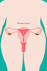 Ovarian cancer diagram showing tumor growth in the ovaries. Eps 10