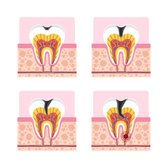Tooth decay 4 stages cross section showing cavity development from enamel to pulp infection for dental education.