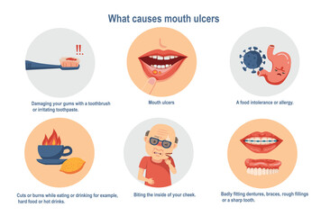 what causes mouth ulcers