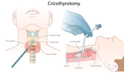 anatomical landmarks and surgical steps of a cricothyrotomy, an emergency airway procedure involving the neck and trachea diagram hand drawn schematic vector illustration. Medical science educational