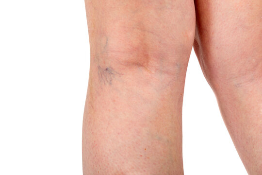 Close up of the beginning of varicose veins below the knee showing visible swollen veins illustrating venous insufficiency and vascular condition for medical and health concepts