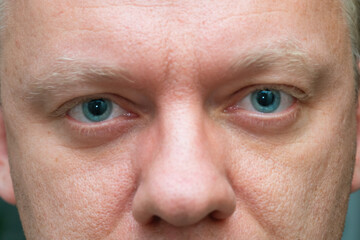 Close-up of a man eyes with dilated pupils, after ophthalmologist performed a pupil dilation to...