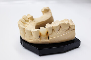 Dental stone model of lower jaw for prosthetic work, Close-up of a dental stone cast showing a lower jaw with detailed teeth anatomy.
