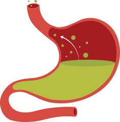 Human stomach full of stomach acid. Acid reflux or gastroesophageal reflux, Heartburn. Stomach disease, stomach problem disease concept. Vector drawing.
