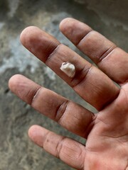 Close up of a human hand with a small skin peel injury caused by friction or hot water burn