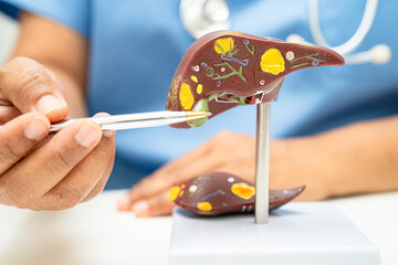 Cirrhosis, Liver cancer, fatty liver, Asian doctor with liver human anatomy model in World Hepatitis Day at hospital.