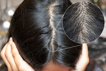 Woman showing hair loss from scalp, thinning hair and bald spots