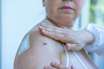 closing surgical wound, Doctor, Nurse treating surgical wound, shoulder injury, sterile tools,...