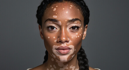 Close up portrait of a woman with vitiligo against a gray background looking forward