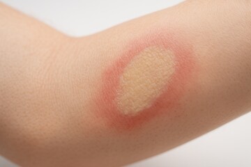 A red ring-shaped skin rash with central clearing, indicating a possible fungal infection or irritation on a human arm