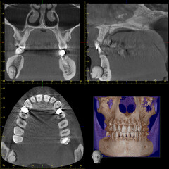 Detailed dental CT scan showing axial, coronal, sagittal, and 3D views of jaw and teeth for diagnostic and treatment planning. © Lilith_Saly