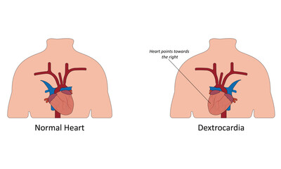 Dextrocardia vector illustration