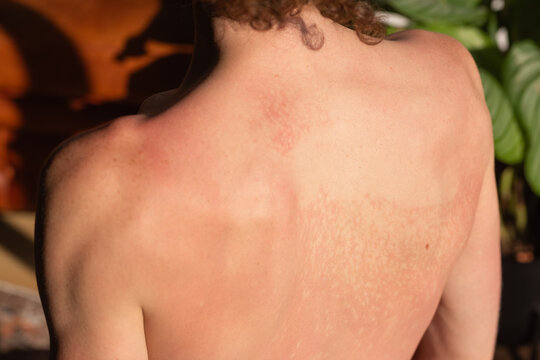 Man with sunburn on back
