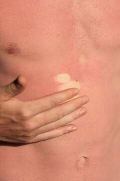 Serious sunburn on skin