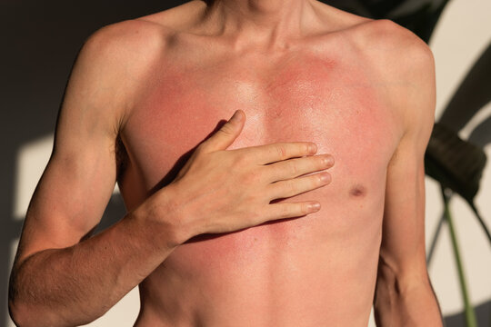 Man smearing healing balm on red skin