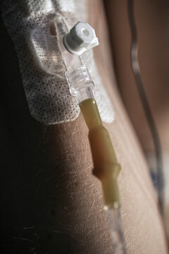 Close up artistic photo of Intravenous drip in the hand 