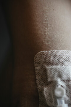 Nude Woman&rsquo;s Arm with Medical IV and &ldquo;Freedom&rdquo; Imprint