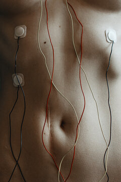 Keloid Scar from Intestinal Volvulus with Medical Electrode