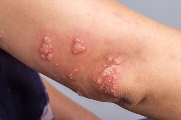 Shingles, Zoster or Herpes Zoster symptoms on arm.