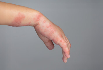 Shingles, Zoster or Herpes Zoster symptoms on arm.