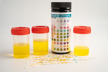 Urinalysis, urine cup with reagent strip pH paper test and comparison chart in laboratory.