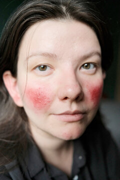 Woman with rosacea wearing blush enhances her natural features