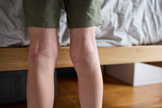 Child's legs with eczema