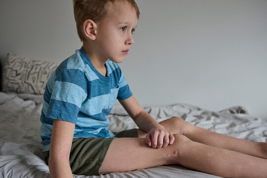 Child's arms and legs with eczema