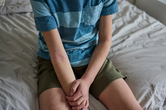 Child's arms with eczema